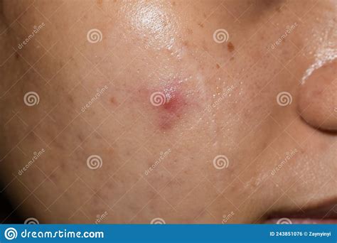 Single Cystic Acne Vulgaris On Oily Face Of Asian Young Woman Stock
