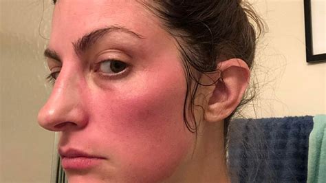 A Redditor Shared Her Allergic Reaction Story To Remind People To Patch
