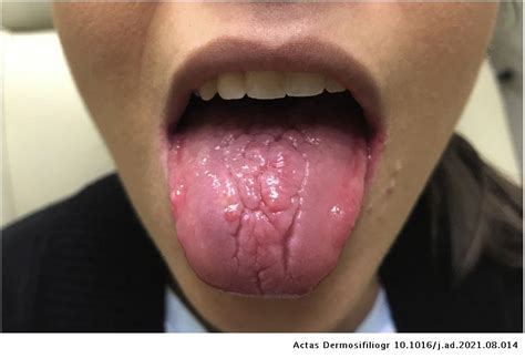 Herpetic Geometric Glossitis In An Immunocompetent Patient Actas