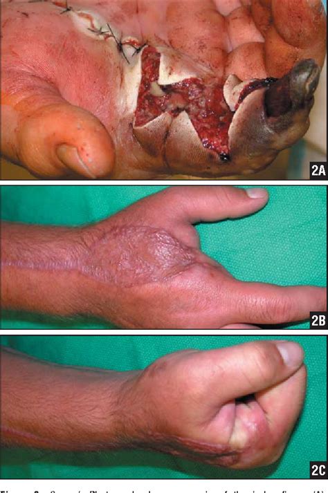 Figure From High Pressure Injection Injuries Of The Hand Semantic