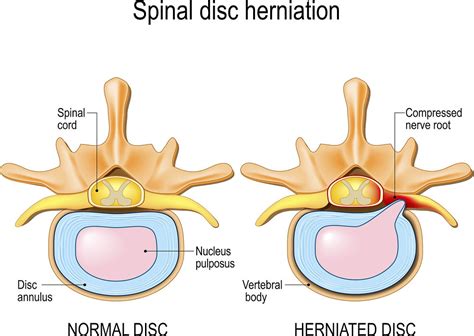 Disc Herniations What Are They And How To Manage Them