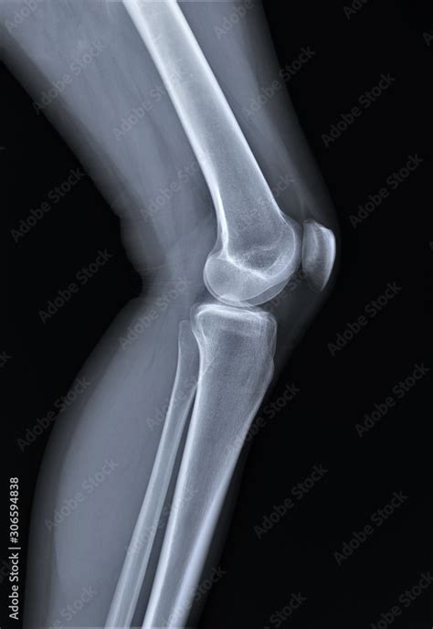 Normal Radiography Of The Knee Joint In Lateral Projection Medical