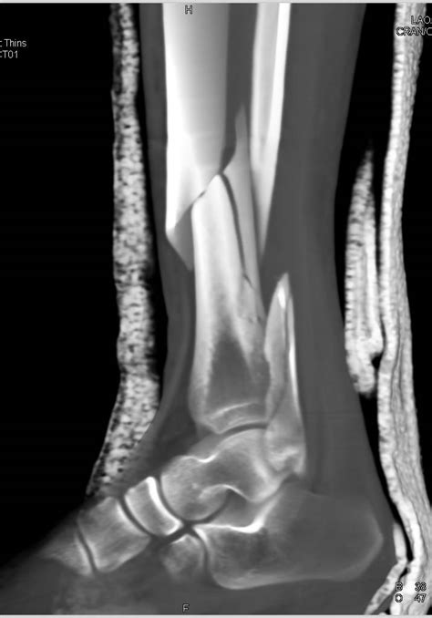 Spiral Fracture Tibia And Fibula Xray Pictures Of Fra Vrogue Co
