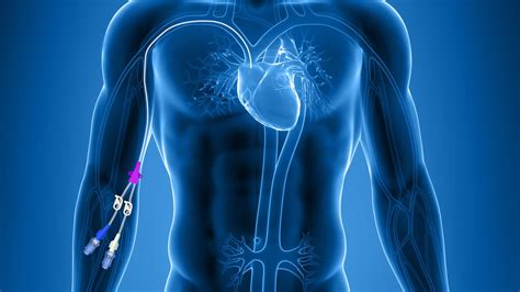 Picc Peripherally Inserted Central Catheter Sonosif By Sifsof