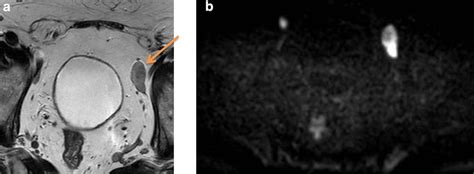 A T2w Images Of Mpmri Showing Hypointense Oval Bi Lobar Left Obturator