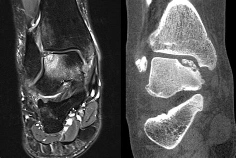 Osteochondral Defect Of The Talus — Chicago Foot And Ankle Orthopaedic