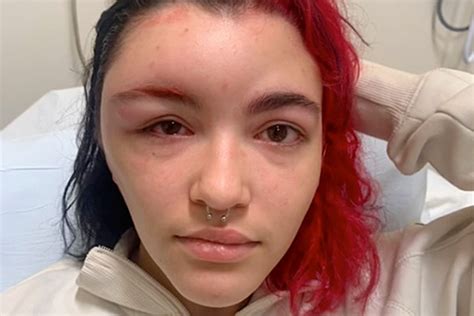 Tiktoker Goes Viral After Face Swells From Allergic Reaction To Hair Dye