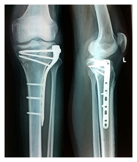 A Radiograph Showing Type V Tibial Plateau Fracture Treated With Open