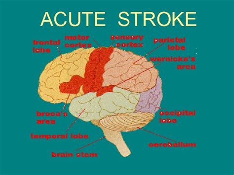 Acute Stroke Definition Defined As A