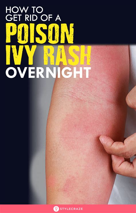 How To Get Rid Of A Poison Ivy Rash Overnight Poison Ivy Rash Poison