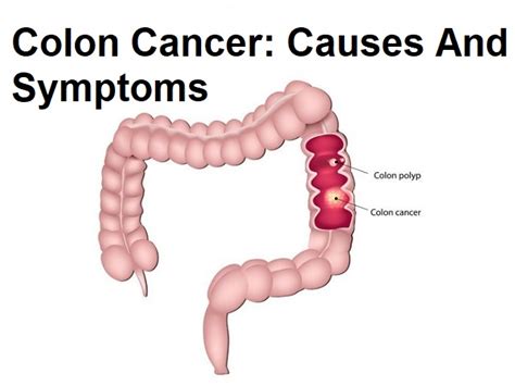 Colon cancer may be unpleasant to talk about, but knowing the symptoms could save your life. The survival rate of colon cancer is 92% when taken early ...