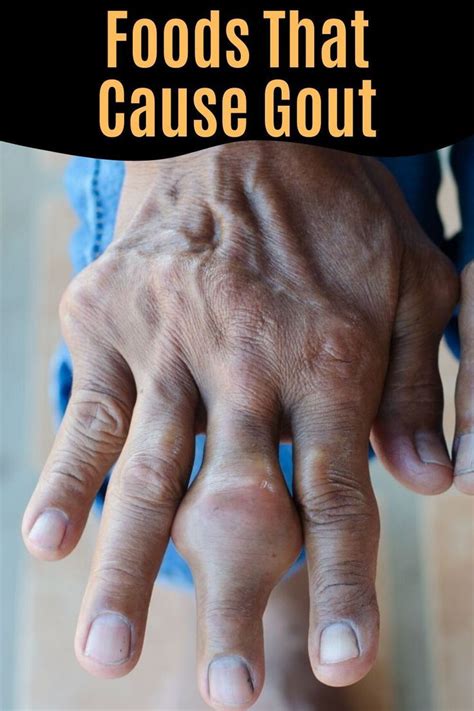 Foods That Cause Gout In 2020 Foods That Cause Gout Gout How To
