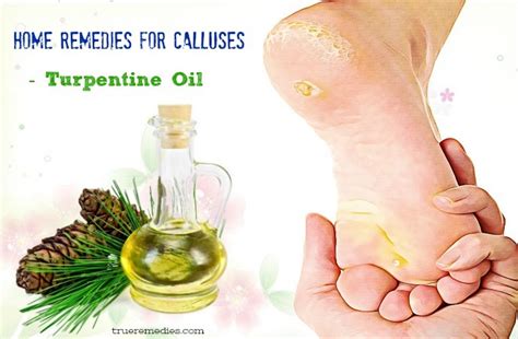 28 Home Remedies For Calluses On Hands And Feet