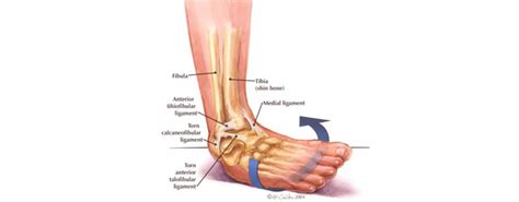 Lateral Ankle Sprain Sydney Sports Physio And Rehab