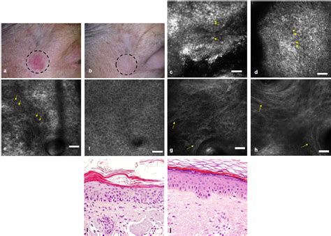 Figure 1 From In Vivo Non Invasive Evaluation Of Actinic Keratoses
