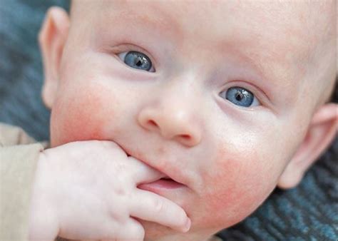 Heat Rash In The Baby What It Is And How To Relieve It Roditelbg