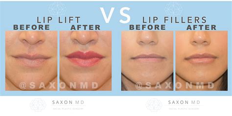 lip lifts vs lip fillers saxon md facial plastic surgery in dallas and austin texas