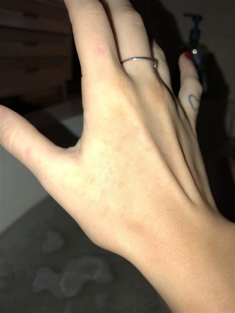 Weird Rash On Handscould It Be An Early Pregnancy Sign Or Is It