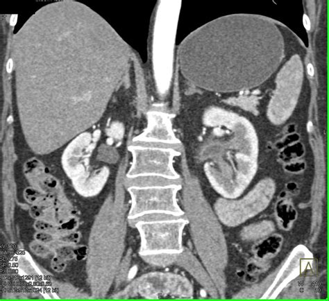 Transitional Cell Carcinoma Left Kidney And Ureter Kidney Case