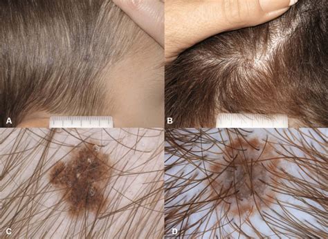 Scalp Nevi In Children A And B Brown Pigmented Macule On Hair