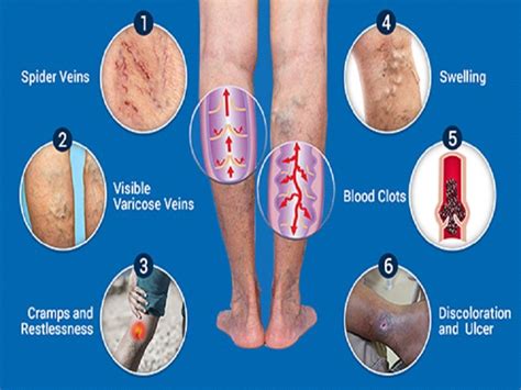 Leg Veins Why They Appear And How Dermatologists Treat Them