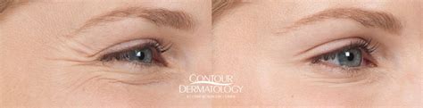 dysport before and after photos contour dermatology