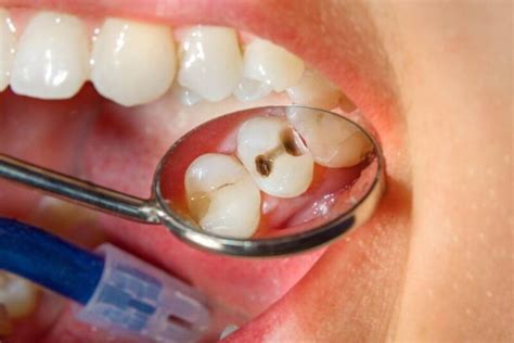Services Minty Fresh Dental And Orthodontics Prosper Tx
