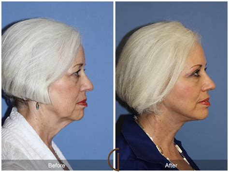 Neck Lift Before And After Photos Patient 02 Dr Kevin Sadati