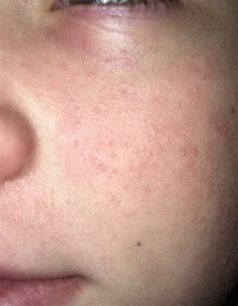 Skin Colored Bumps On Cheeks And Forehead General Acne Discussion