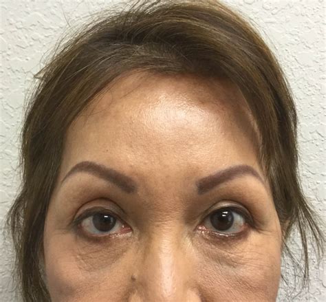 Coronal lifts are ideal for individuals with. Before and After Brow Lift Photos