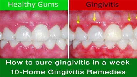 How To Cure Gingivitis In A Week 10 Home Gingivitis Remedies Cb Pro