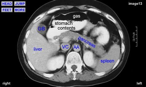 Normal Ct Abdominal With Label Abdomen Organs Abdominal
