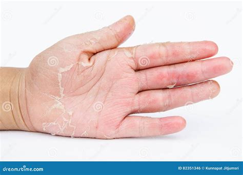 Dry Hands Peel Contact Dermatitis Fungal Infections Skin Inf Stock