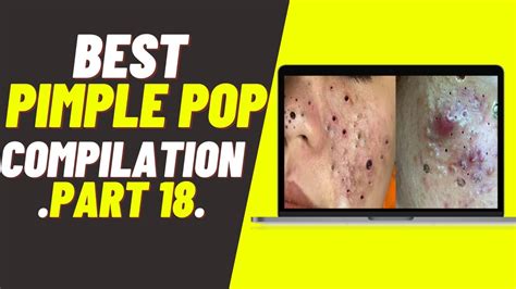 Satisfying Pimple Pop 💦 And Blackheads Removal Compilation Part 18