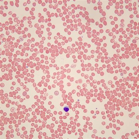 Human Sickle Cell Anemia Slide Smear Wrights Stain