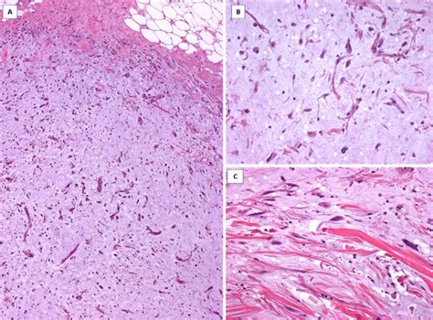 Myxoma A A Myxoid Tumor With Circumscribed Margins B Higher