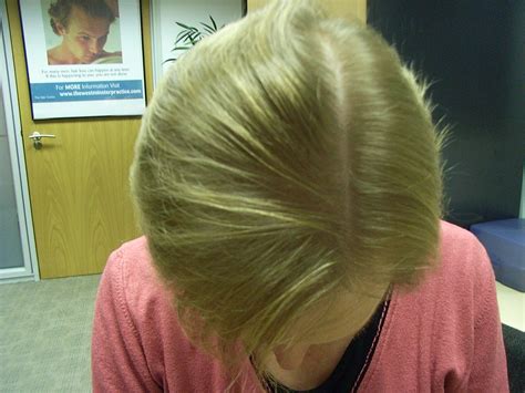 The Hair Loss Centre FEMALE HAIR LOSS