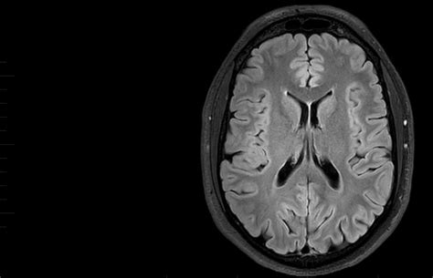 Mri Brain Scan Melbourne Radiology Clinic Mri At Melbourne