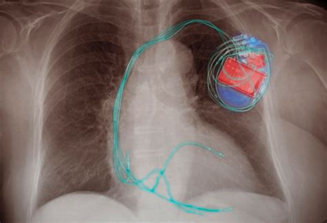 Can Implantable Pacemakers And Defibrillators Be Hacked
