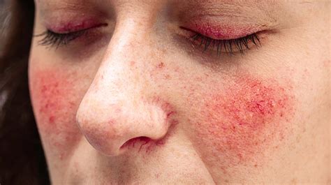 Causes Of Rosacea Treatments Types And Symptoms