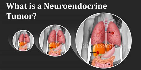 Neuroendocrine Tumors Types Symptoms Causes Risks Treatment And