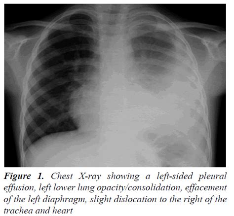 Atypical Kawasaki Disease Presenting As Refractory Pneumonia