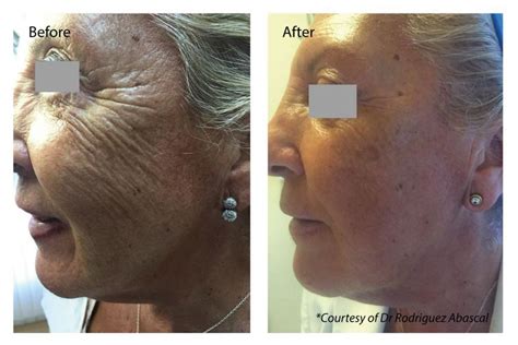 Profhilo Before And After Dundrum Cosmetic Clinic