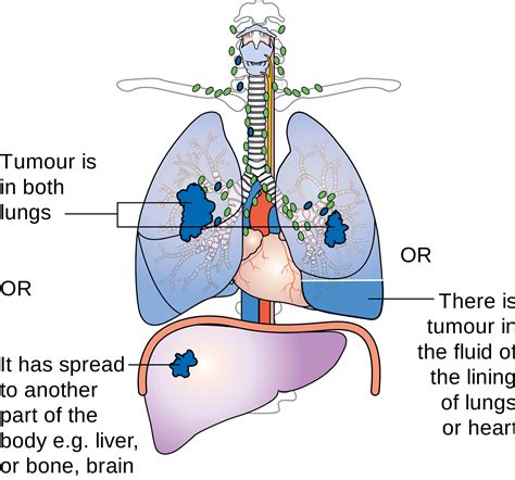 lung cancer - what is cancer - prostate cancer - pancreatic cancer: Asbestos Lung Cancer - How 