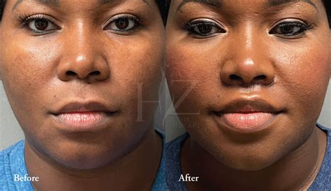 upper lip lift before and after — hz plastic surgery