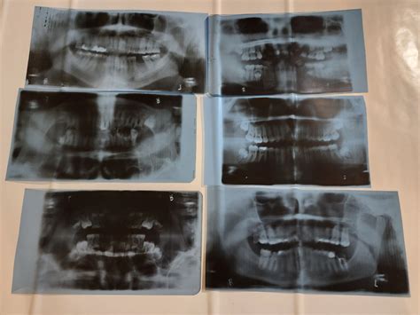 Full Mouth Dental X Rays Etsy