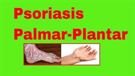 Psoriasis Palmar Plantar Psoriasis Palmoplantar Youtube