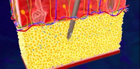 This surgery will not remove cellulite. How Does Liposuction Work - Plastic Surgery | OptimalSelf MD