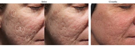 Acne Scar Filler Before And After Photos Irvine