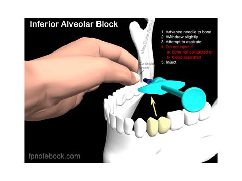 Modifications Of Inferior Alveolar Nerve Block Techni